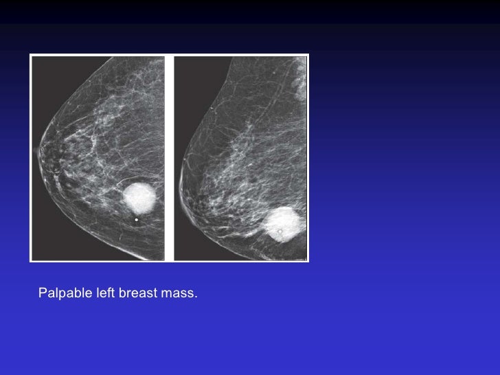 palpable lump on left breast Nude photos shadows